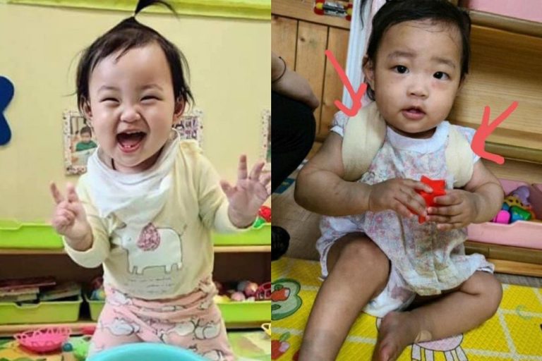 Pankreas pecah, tempurung kepala retak, tulang patah. Bayi didera 271 hari sehingga mati