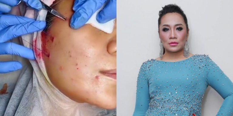 Amelina sangkal dakwaan ubah wajah, hanya rawatan…