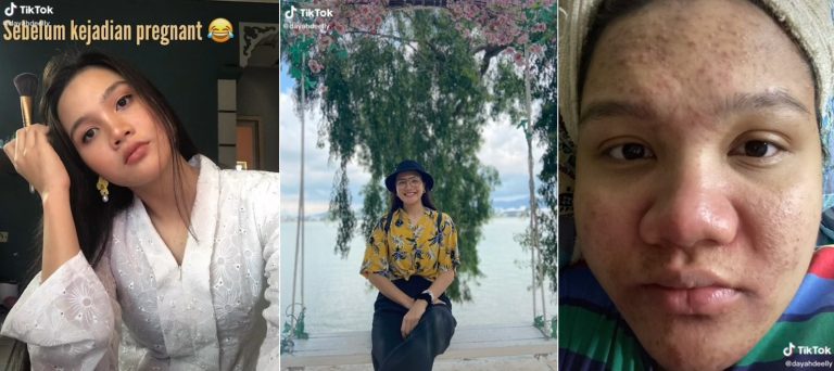 Wanita cantik menjadi ‘orang lain’ – muka, badan dipenuhi jerawat ketika mengandung