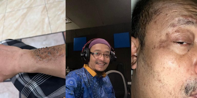 Kazim Elias Dedah Hidap Penyakit Misteri Sampai Luka Berdarah