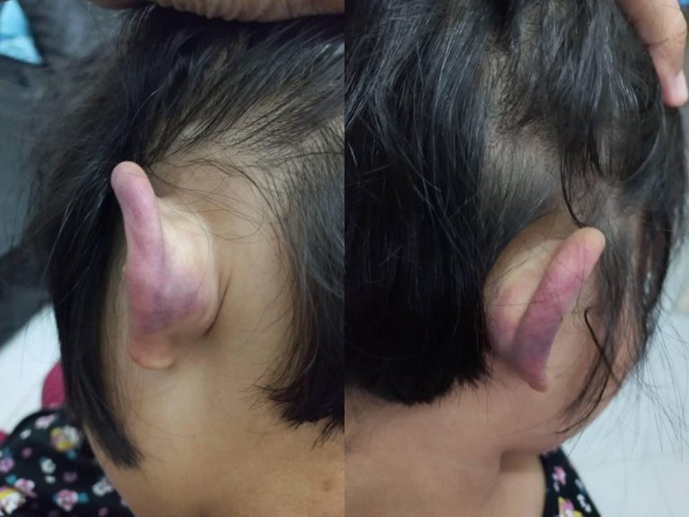 Polis siasat guru pulas telinga kanak-kanak autisme hingga lebam