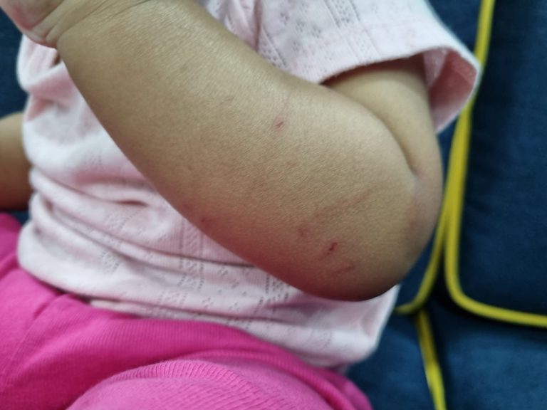 Anak cedera dihantar ke taska digigit kanak-kanak seusia