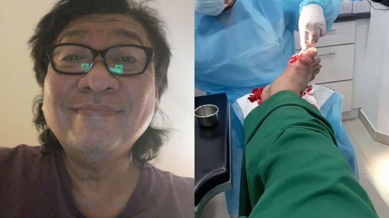 Roy lega ibu jari kaki tak perlu dipotong