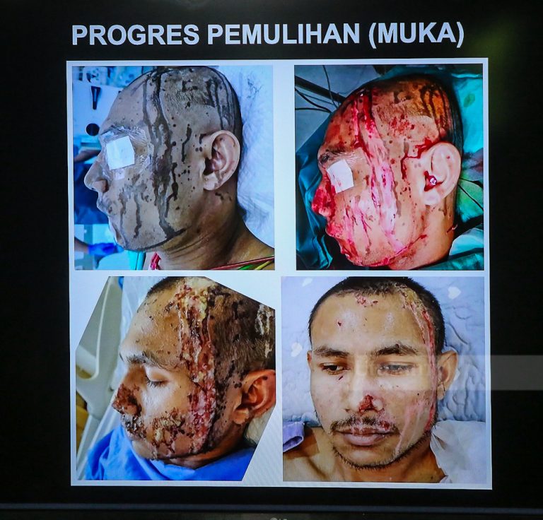 Kes simbah asid Faisal diklasifikasikan sebagai tiada tindakan lanjut