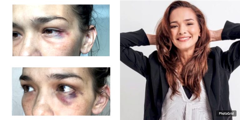 Zahnita Wilson dedah 20 tahun bertahan jadi mangsa keganasan rumah tangga, kongsi gambar mata lebam kesan dipukul suami!